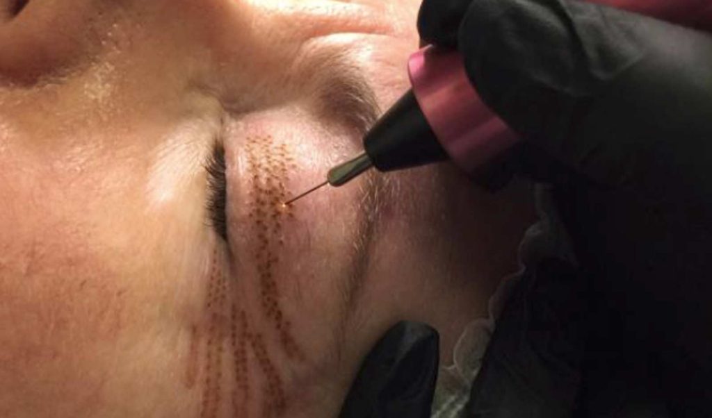 planoplas-pro-plasma-fibroplasting-be-laser-and-skin-clinic