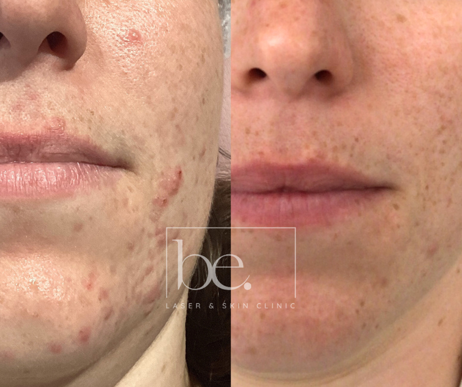 Acne Scarring Treatment before and after with be laser and skin clinic a face with and then without acne
