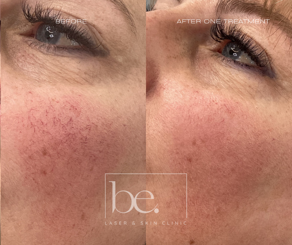 Vessel and pigmentation skin laser treatment photos