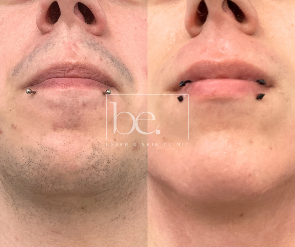 before and after laser hair removal be aesthetics taunton