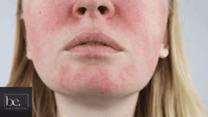 redness in ladies face