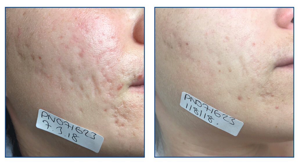 photo of acne scarring treatment be laser skincare taunton