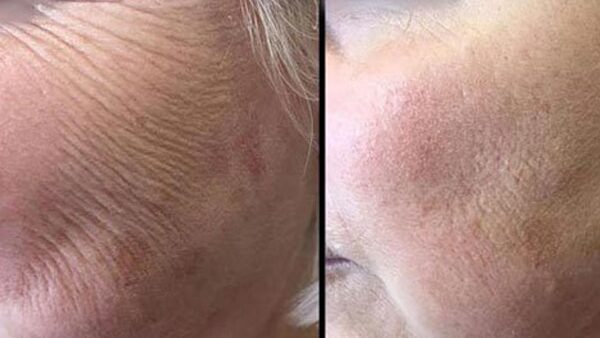 wrinkles and lines treatment