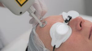 erbium laser treatment for skin taunton