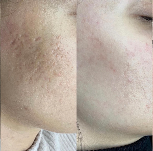 photo of womans face side on before and after skin treatment to reduce texture