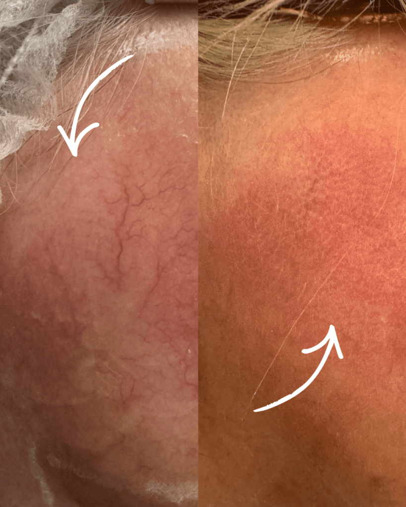 vessel and pigmentation before and after pic on cheek