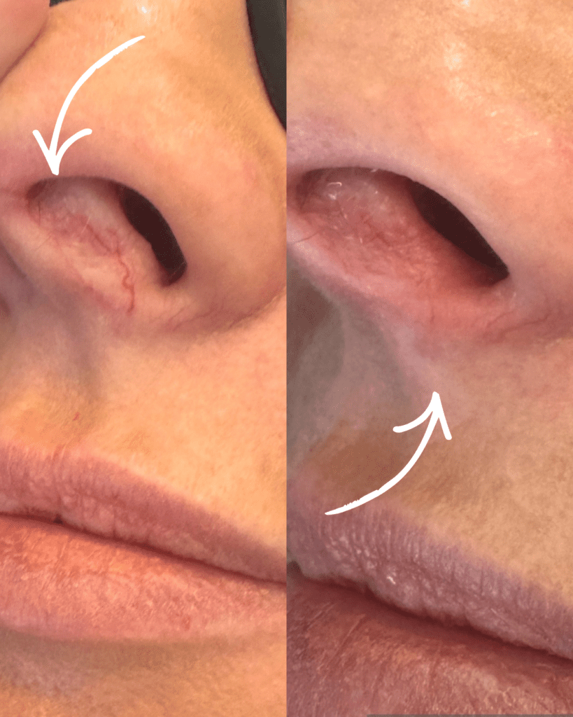 vessel and pigmentation before and afters (2)