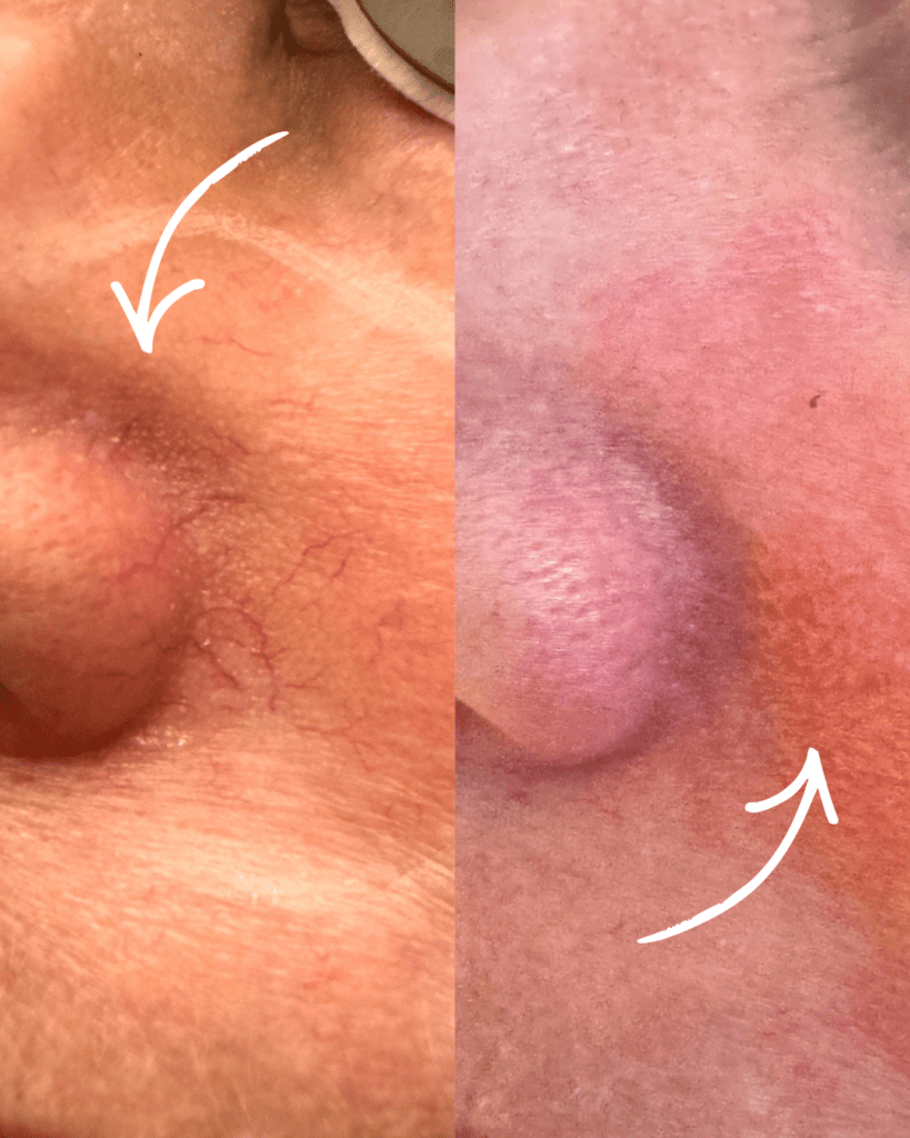 vessel and pigmentation before and after pic around nostril
