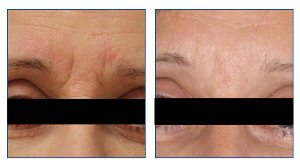 before and after photos of lines and wrinkles treatment
