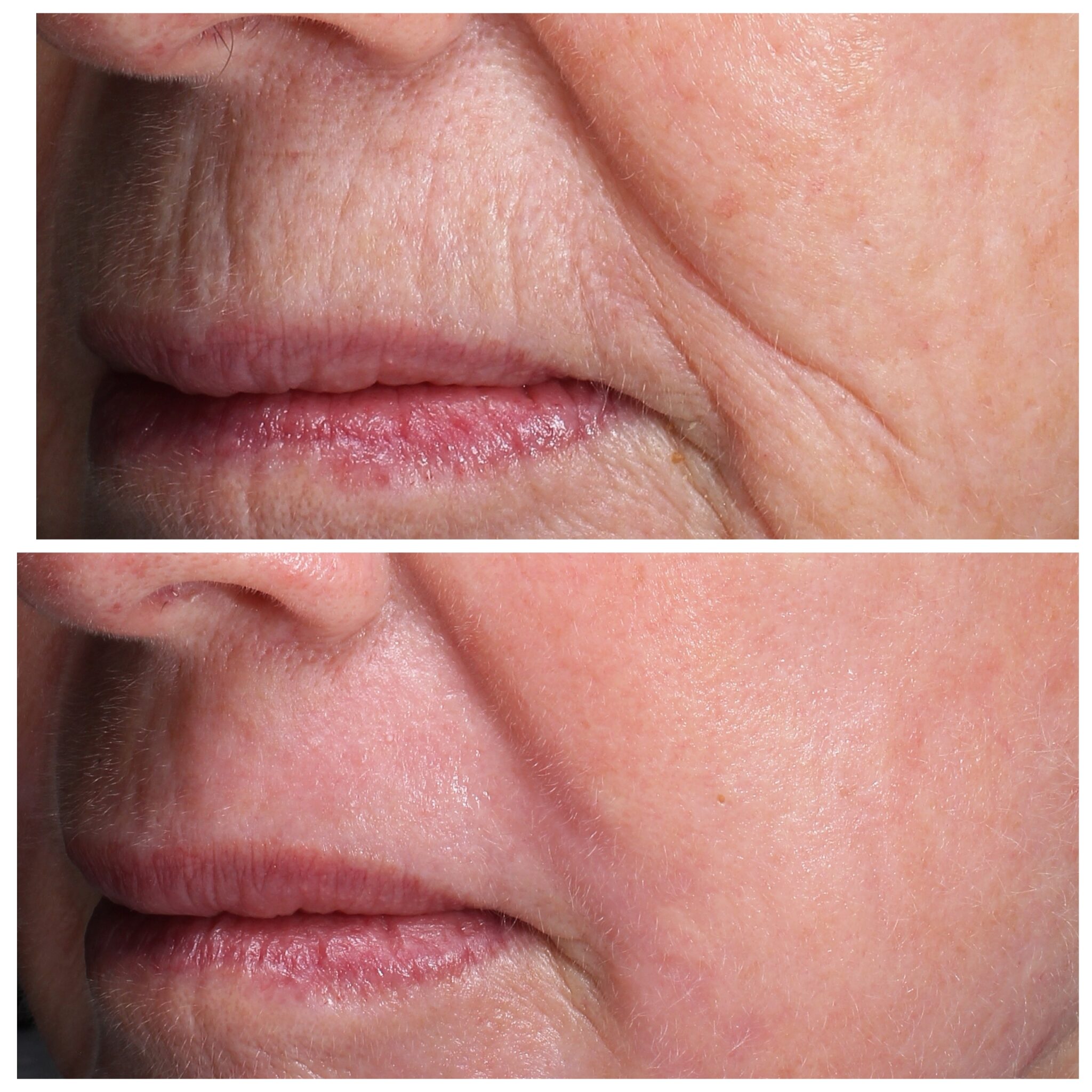 before and after photos of lines and wrinkles treatment